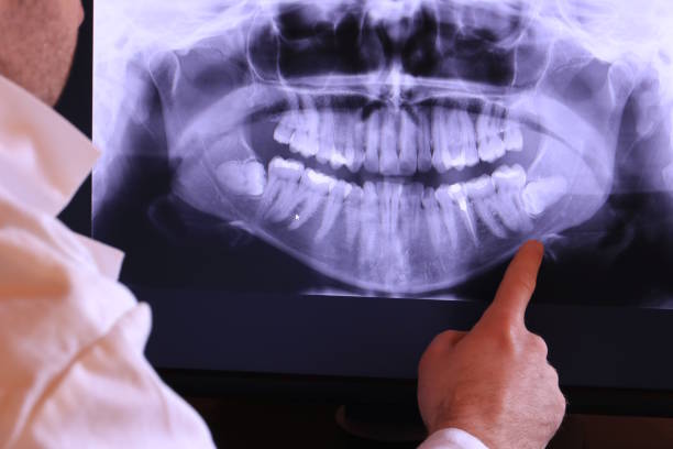 Best Emergency Dental Care for Abscessed Tooth in Avila Beach, CA