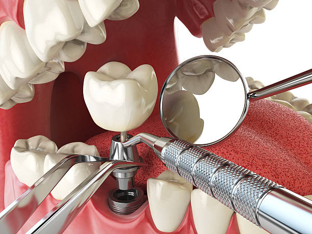 Best Emergency Dentist for Knocked-Out Tooth in Avila Beach, CA